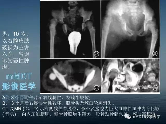 【PPT】无痛无汗症的影像诊断