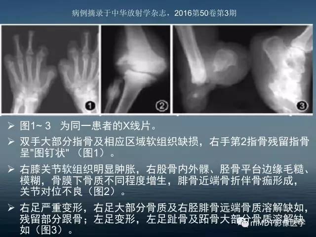 【PPT】无痛无汗症的影像诊断