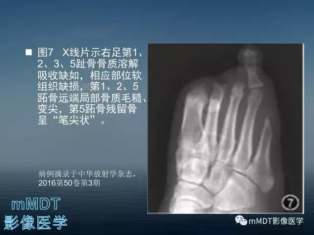 【PPT】无痛无汗症的影像诊断