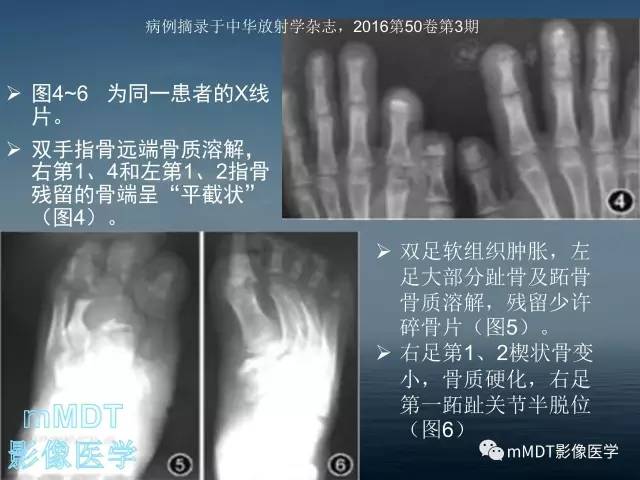 【PPT】无痛无汗症的影像诊断