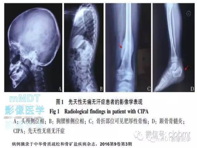 【PPT】无痛无汗症的影像诊断