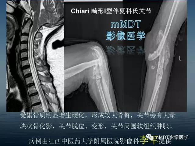 【PPT】无痛无汗症的影像诊断
