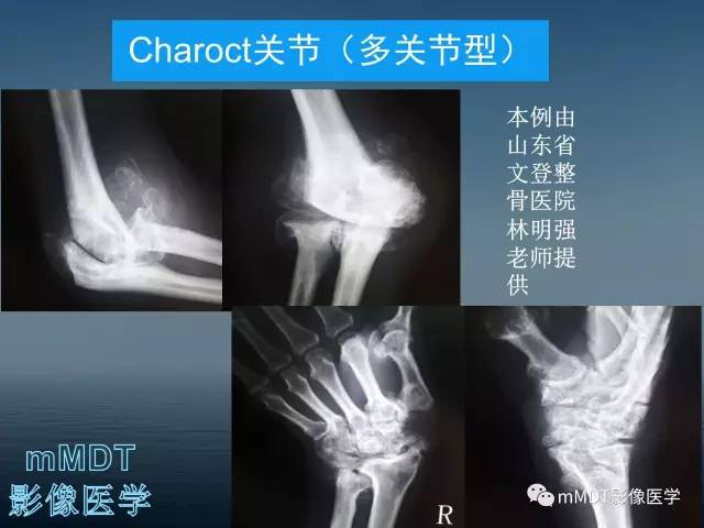 【PPT】无痛无汗症的影像诊断