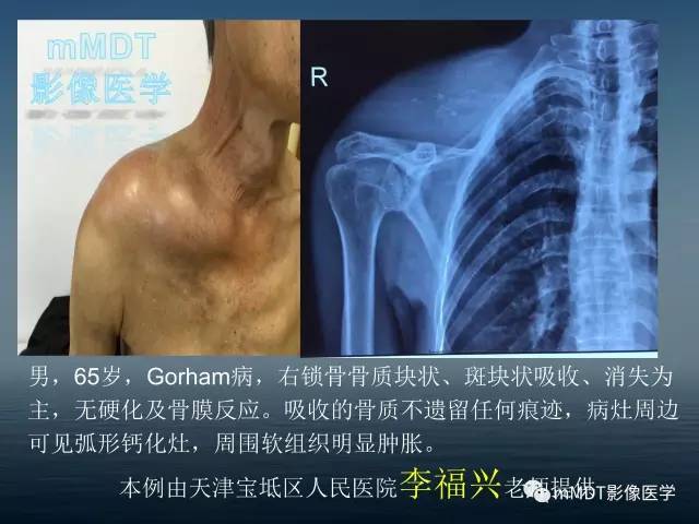 【PPT】无痛无汗症的影像诊断