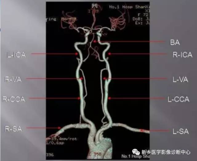 头颈部血管常见变异35例汇总 头颈部血管常见变异35例汇总