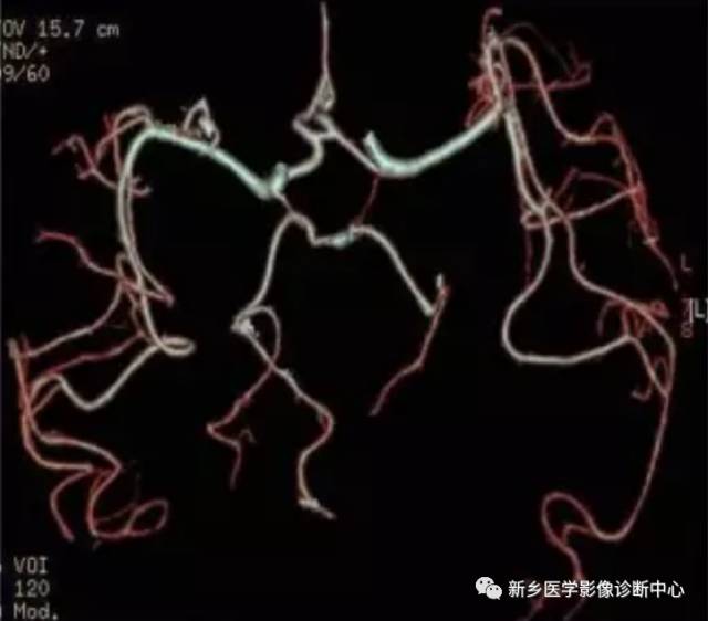 头颈部血管常见变异35例汇总