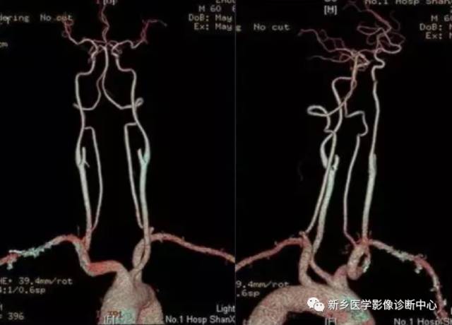 头颈部血管常见变异35例汇总 头颈部血管常见变异35例汇总