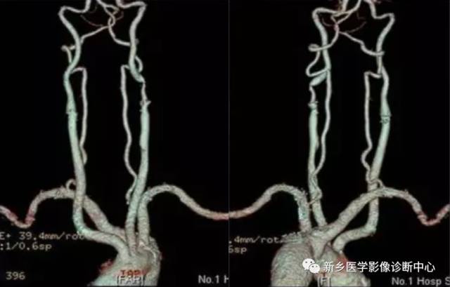头颈部血管常见变异35例汇总