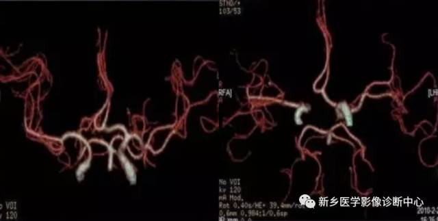 头颈部血管常见变异35例汇总 头颈部血管常见变异35例汇总