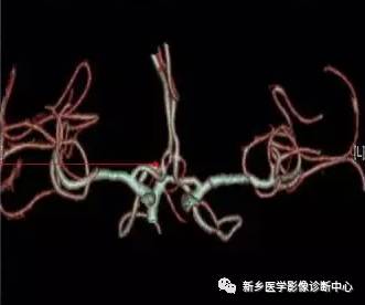 头颈部血管常见变异35例汇总 头颈部血管常见变异35例汇总