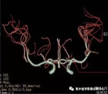 头颈部血管常见变异35例汇总 头颈部血管常见变异35例汇总