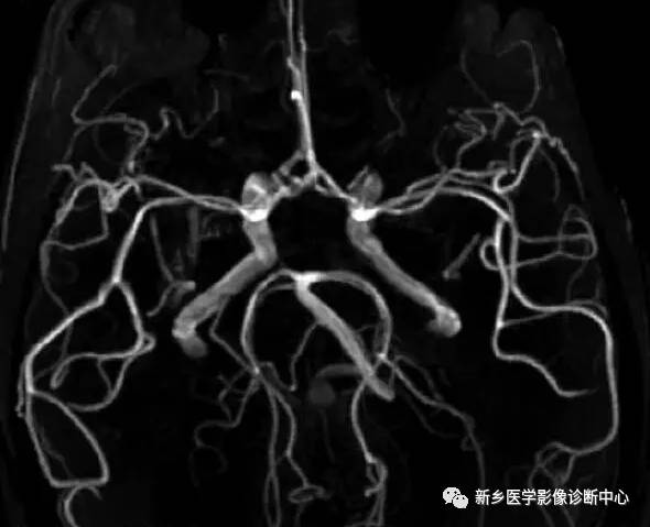 头颈部血管常见变异35例汇总