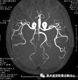 头颈部血管常见变异35例汇总 头颈部血管常见变异35例汇总