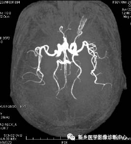 头颈部血管常见变异35例汇总 头颈部血管常见变异35例汇总