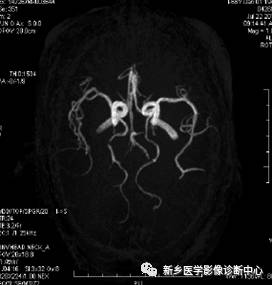 头颈部血管常见变异35例汇总 头颈部血管常见变异35例汇总