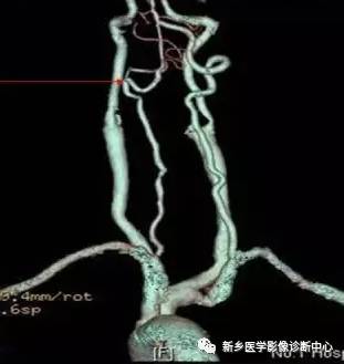 头颈部血管常见变异35例汇总 头颈部血管常见变异35例汇总