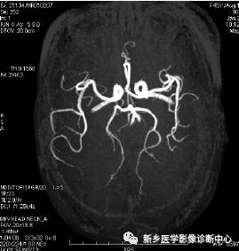 头颈部血管常见变异35例汇总 头颈部血管常见变异35例汇总
