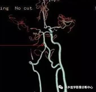 头颈部血管常见变异35例汇总 头颈部血管常见变异35例汇总