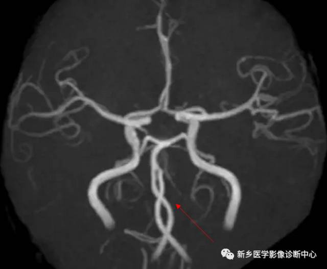 头颈部血管常见变异35例汇总
