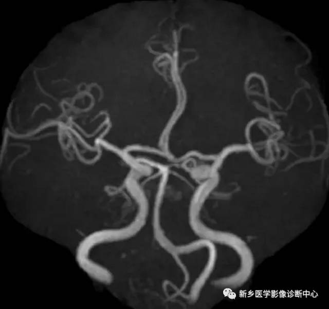 头颈部血管常见变异35例汇总