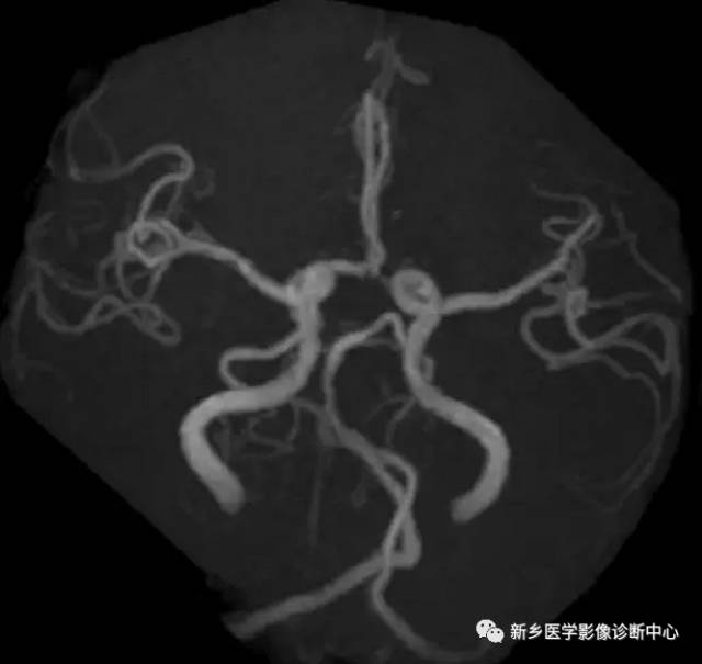 头颈部血管常见变异35例汇总