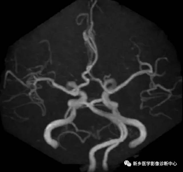 头颈部血管常见变异35例汇总