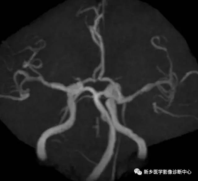 头颈部血管常见变异35例汇总