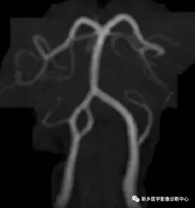 头颈部血管常见变异35例汇总
