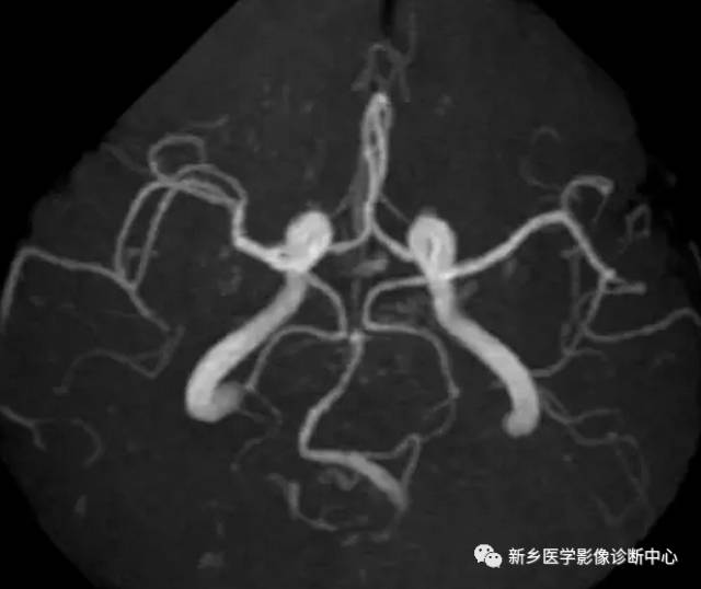 头颈部血管常见变异35例汇总