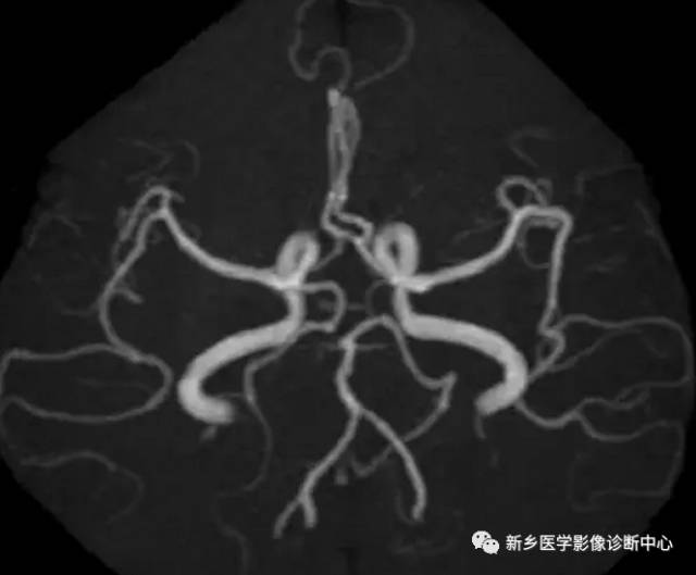 头颈部血管常见变异35例汇总