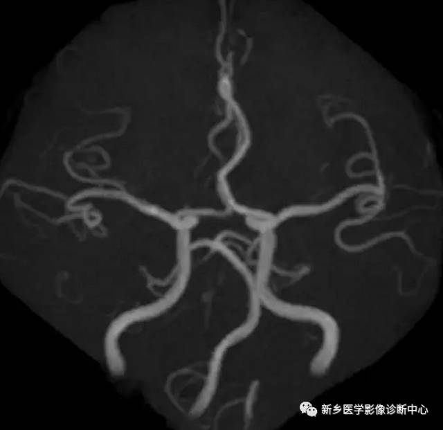 头颈部血管常见变异35例汇总