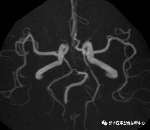 头颈部血管常见变异35例汇总