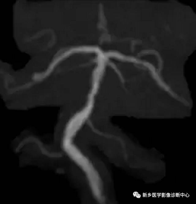 头颈部血管常见变异35例汇总