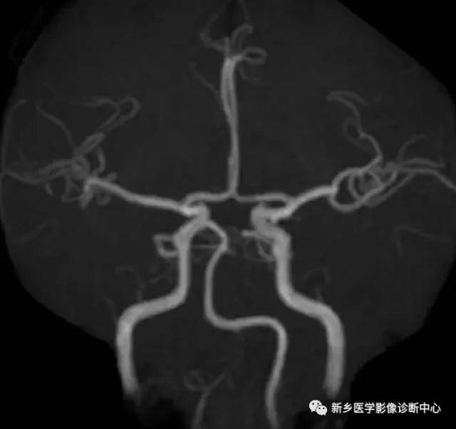 头颈部血管常见变异35例汇总