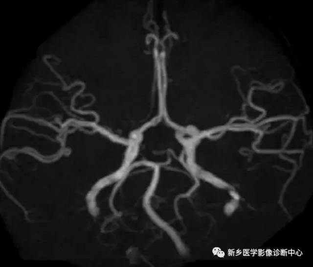 头颈部血管常见变异35例汇总