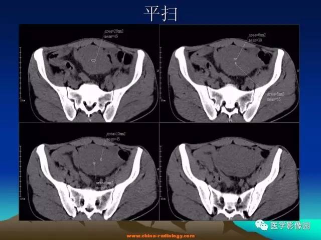 【病例】胃肠道外间质瘤1例CT影像表现