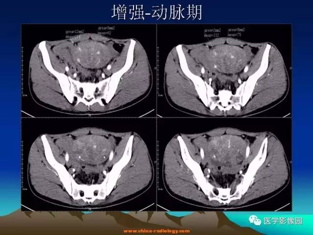 【病例】胃肠道外间质瘤1例CT影像表现 【病例】胃肠道外间质瘤1例CT影像表现