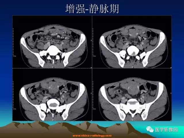 【病例】胃肠道外间质瘤1例CT影像表现 【病例】胃肠道外间质瘤1例CT影像表现