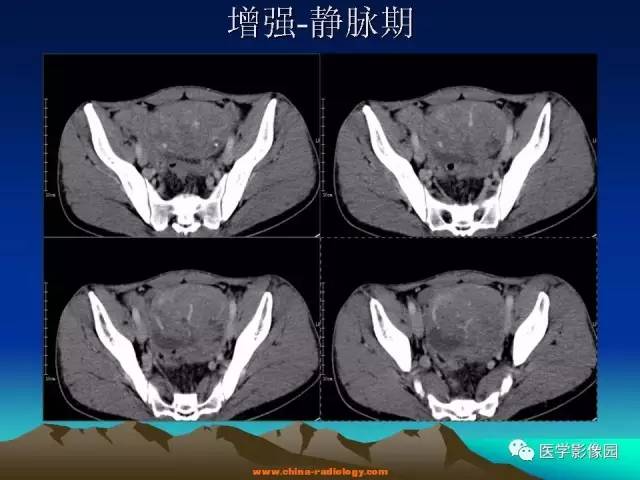 【病例】胃肠道外间质瘤1例CT影像表现 【病例】胃肠道外间质瘤1例CT影像表现