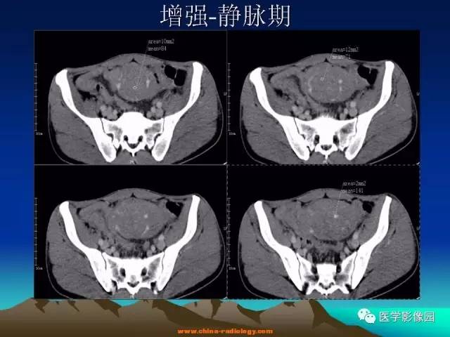 【病例】胃肠道外间质瘤1例CT影像表现 【病例】胃肠道外间质瘤1例CT影像表现