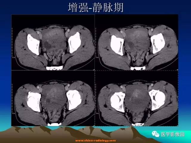 【病例】胃肠道外间质瘤1例CT影像表现 【病例】胃肠道外间质瘤1例CT影像表现