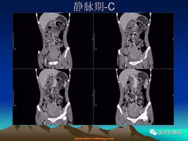【病例】胃肠道外间质瘤1例CT影像表现 【病例】胃肠道外间质瘤1例CT影像表现