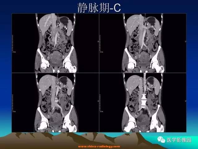 【病例】胃肠道外间质瘤1例CT影像表现 【病例】胃肠道外间质瘤1例CT影像表现
