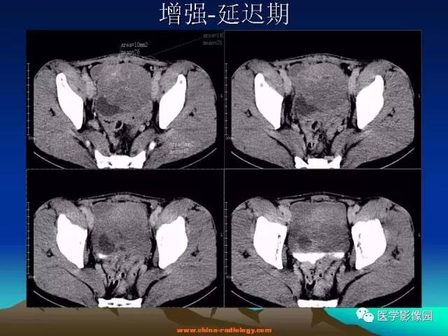 【病例】胃肠道外间质瘤1例CT影像表现 【病例】胃肠道外间质瘤1例CT影像表现