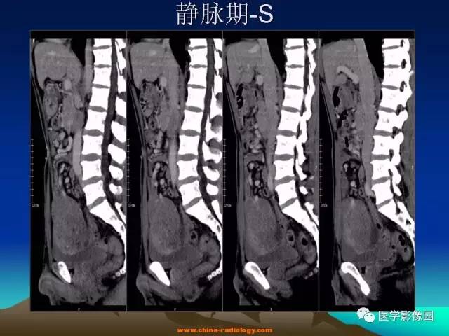 【病例】胃肠道外间质瘤1例CT影像表现 【病例】胃肠道外间质瘤1例CT影像表现