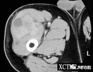【病例】右大腿恶性纤维组织细胞瘤1例CT及MR