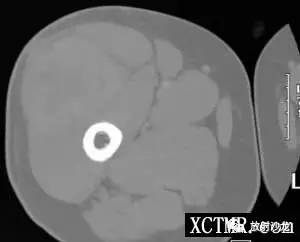 【病例】右大腿恶性纤维组织细胞瘤1例CT及MR