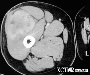 【病例】右大腿恶性纤维组织细胞瘤1例CT及MR 【病例】右大腿恶性纤维组织细胞瘤1例CT及MR