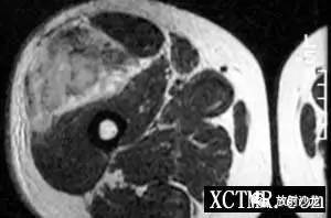 【病例】右大腿恶性纤维组织细胞瘤1例CT及MR 【病例】右大腿恶性纤维组织细胞瘤1例CT及MR