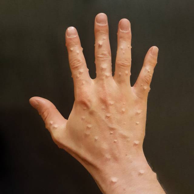 历年愚人节病例大盘点,今年的骶骨去哪了? 历年愚人节病例大盘点,今年的骶骨去哪了?